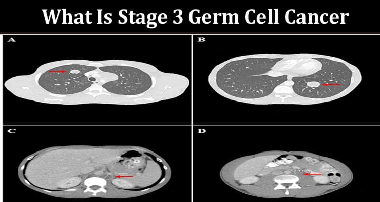Latest News What Is Stage 3 Germ Cell Cancer