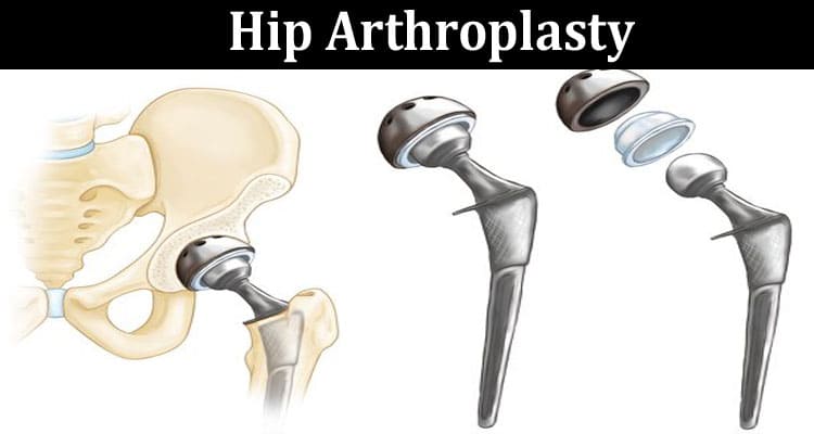 Complete Guide toInformation Hip Arthroplasty