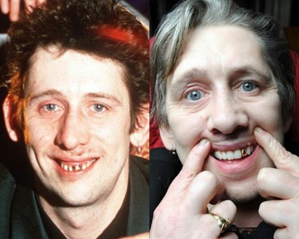 Was Shane Macgowan Weight Loss Linked to Disability